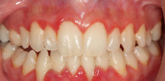 التهاب اللثة (gingivitis)