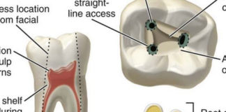 Access cavity ل Mandibular first molar