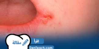 angular cheilitis