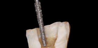 أفضل المحاضرات في ال Access cavity preparation