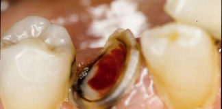 تشخيص وعلاج امراض الجذور الاسعافية Endodontic Emergencies