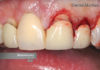 Crown lengthening platform