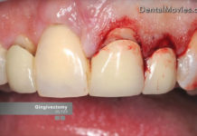 Crown lengthening platform