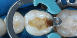 Operative restorations step by step platform