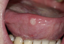 Oral Ulcers platform