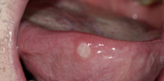 Oral Ulcers platform