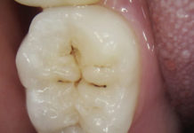 Preventive resin restorations platform