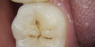 Preventive resin restorations platform