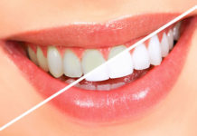 Teeth Bleaching platform