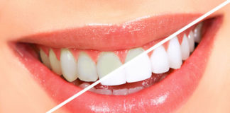 Teeth Bleaching platform