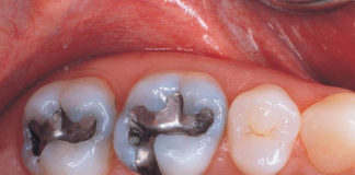 Amalgam Restorations platform