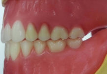 Occlusion platform