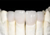 Zirconia Crowns platform
