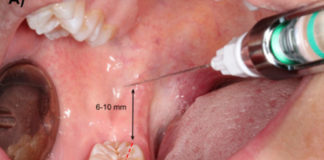 Inferior alveolar nerve block IANB