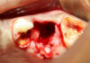 Dry Socket Management Skill