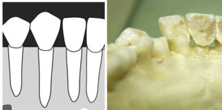 Mandibular Canines (Cuspids) Radiographic landmarks