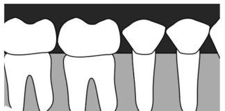 Mandibular Premolars (Bicuspids) Radiographic landmarks