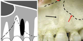 Maxillary Canines (Cuspids) Radiographic landmarks