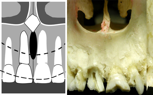 Maxillary Incisors Radiographic Landmarks Denteach