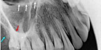 Maxillary Occlusal Lateral Radiographic landmarks