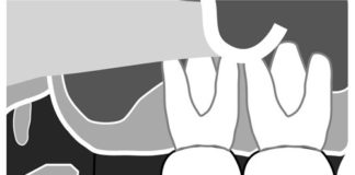 Maxillary Molars Radiographic landmarks