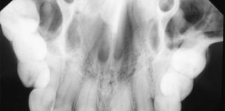 Maxillary Occlusal Topographic Radiographic landmarks