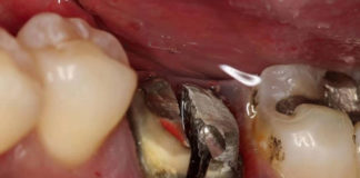 Sectioning Mandibular #6 for Extraction - Skill