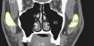 Coronal view landmarks