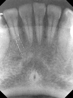 mandibular Incisor1