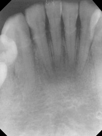 mandibular Incisor2
