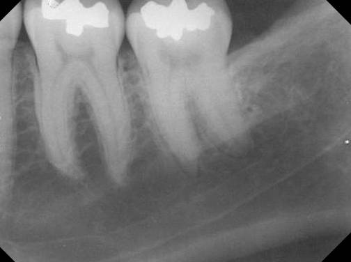 mandibular molar1