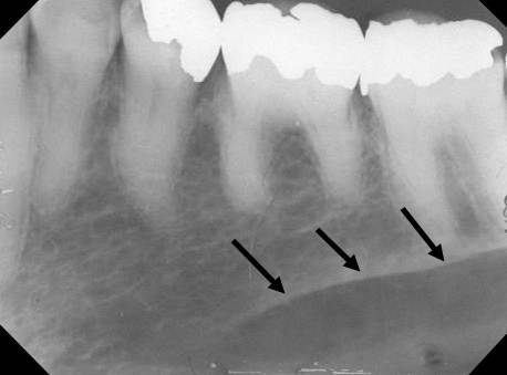 mandibular premolar1