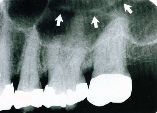 maxillary-premolars2