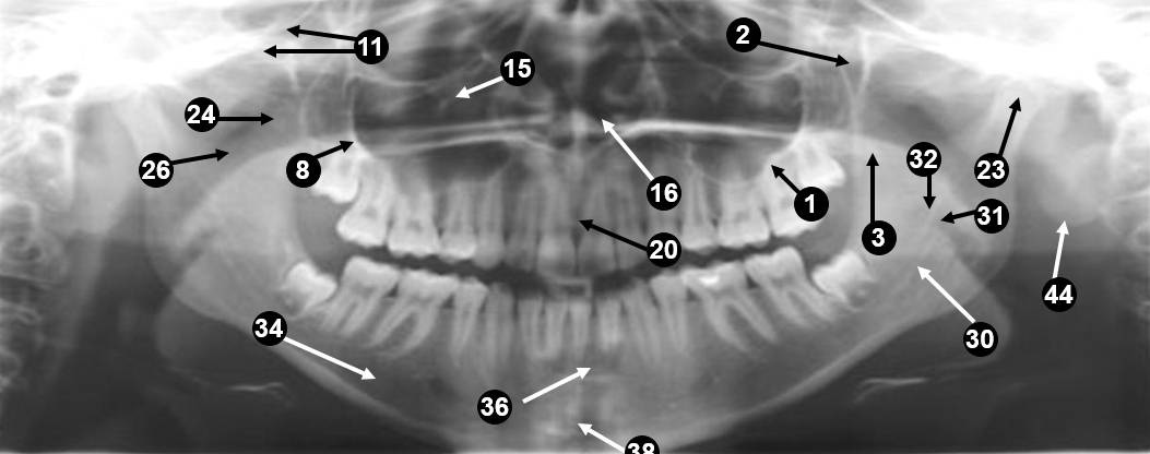 panoramic-xray2