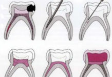 Pulpectomy in Primary teeth - Treatment