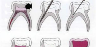 Pulpectomy in Primary teeth - Treatment