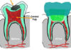Pulpotomy in Primary teeth | Treatment