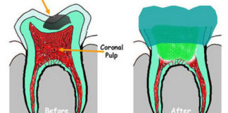 Pulpotomy in Primary teeth | Treatment