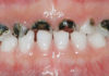 Rampant caries in Primary teeth - Academic Knowledge