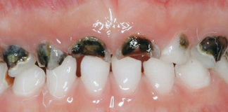 Rampant caries in Primary teeth - Academic Knowledge