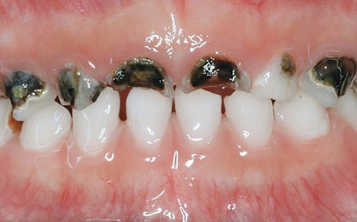 Rampant caries in Primary teeth | Academic Knowledge