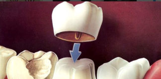 Crowns & Bridges - Dentistry online