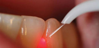 Laser in dentistry - Dentistry online