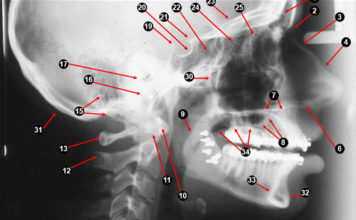 Extra-oral Radiographic landmarks - Quiz