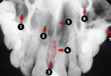 Occlusal Radiographic landmarks - Quiz