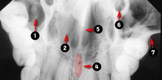 Occlusal Radiographic landmarks - Quiz