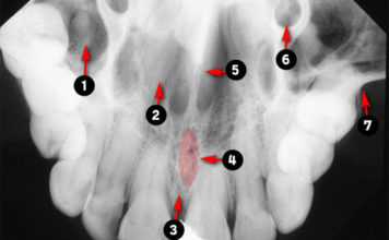 Occlusal Radiographic landmarks - Quiz