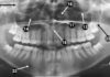 Panoramic Radiographic landmarks - Quiz