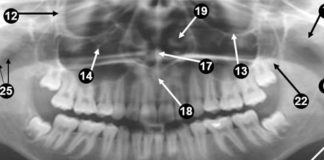 Panoramic Radiographic landmarks - Quiz