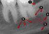 Periapical Radiographic landmarks - Quiz